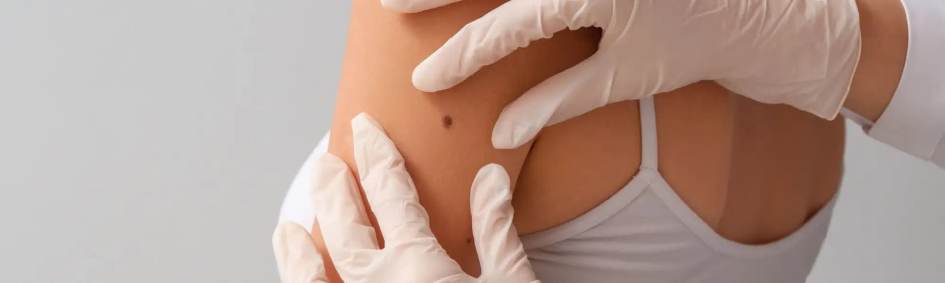 Czerniak skóry: jak zapobiegać i dbać o bezpieczeństwo skóry