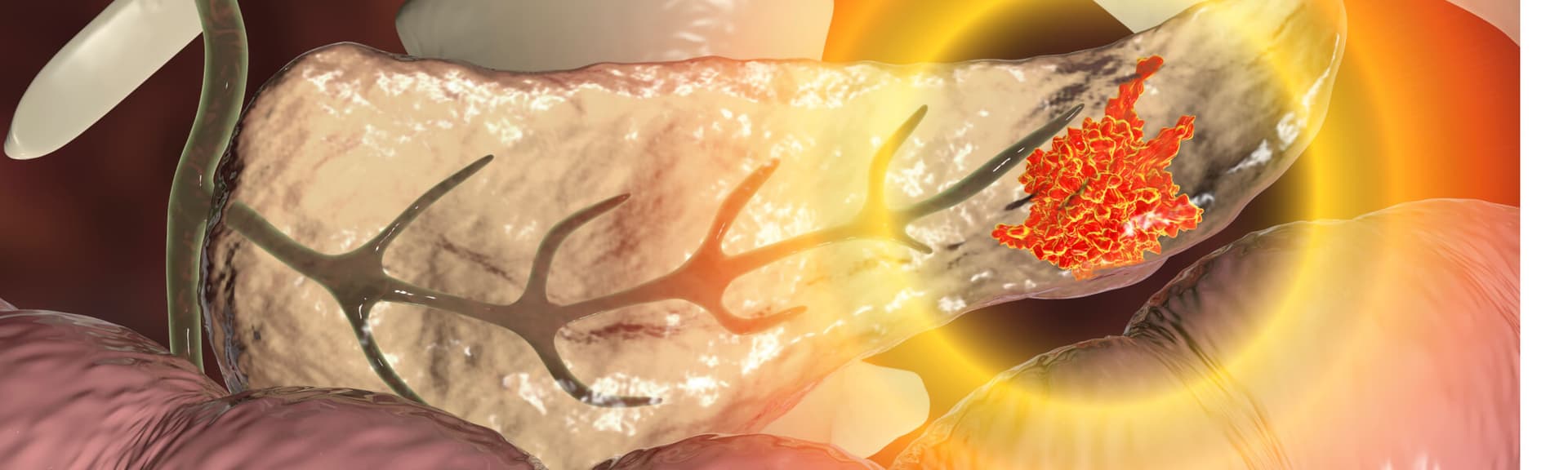 Rak trzustki - objawy, diagnostyka, profilaktyka