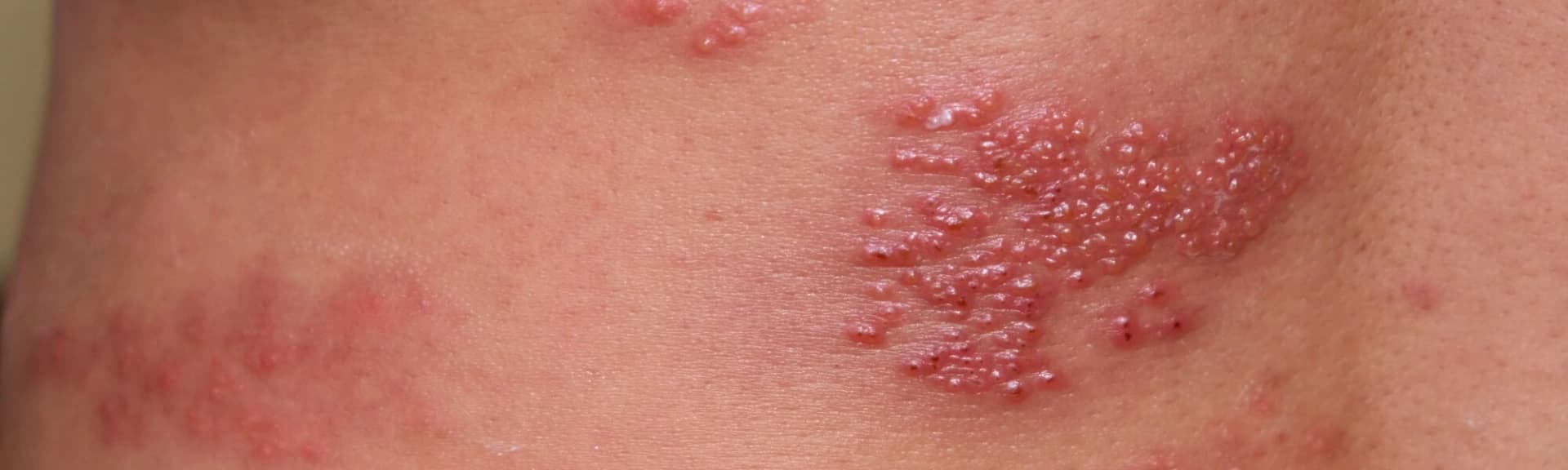 Choroba Duhringa — co to, objawy, przyczyny, leczenie