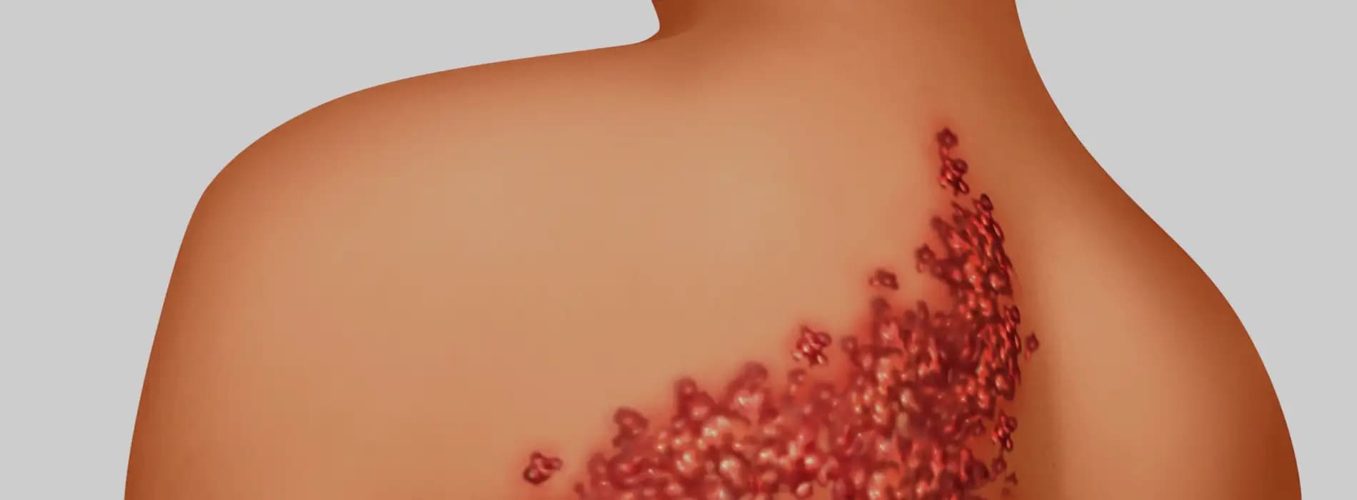 Półpasiec u dzieci i dorosłych - objawy, leczenie