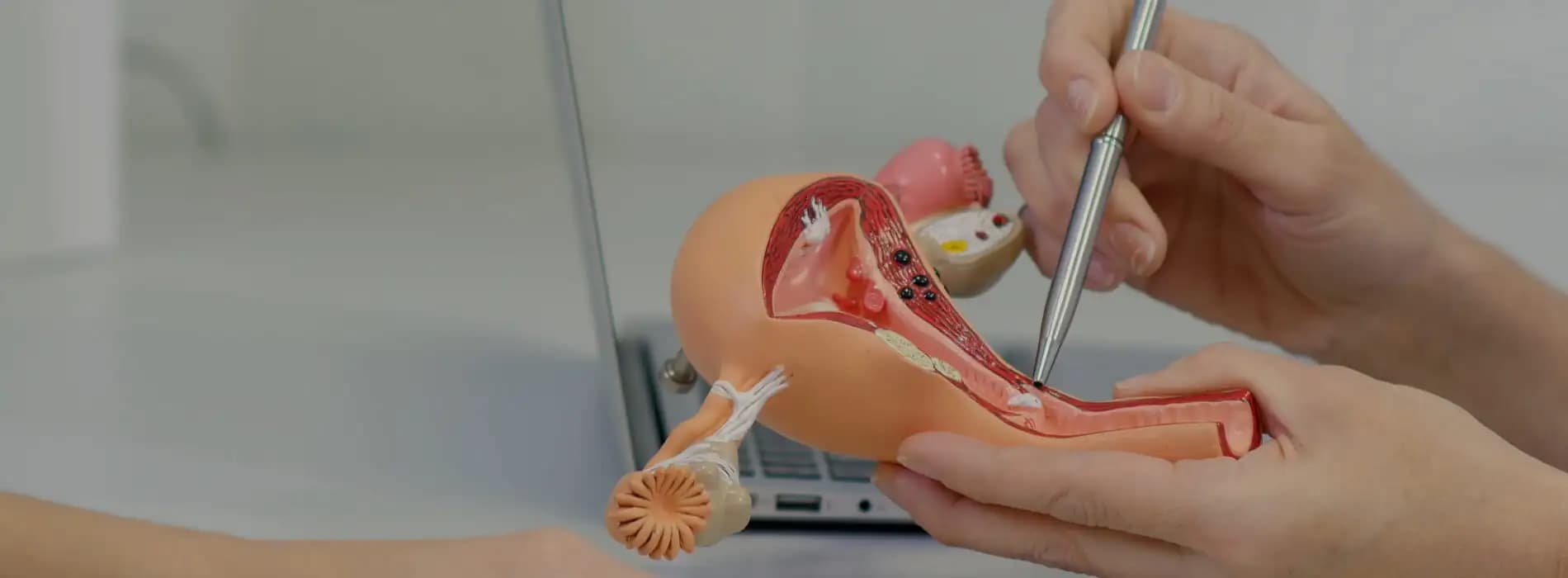 Rak trzonu macicy (endometrium)