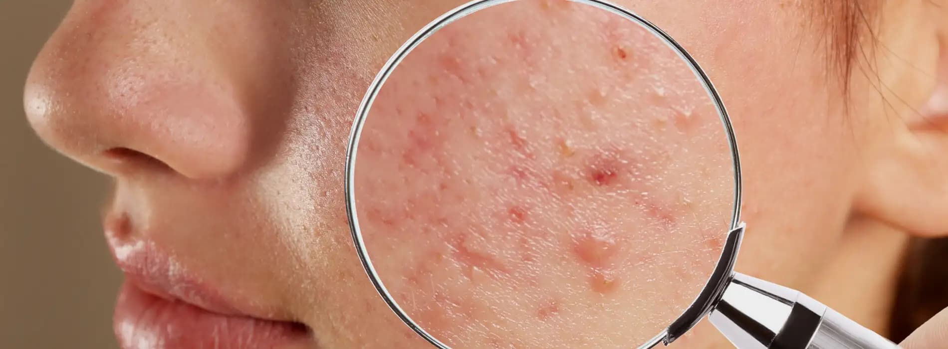 Trądzik - skąd się bierze i jak się go pozbyć?