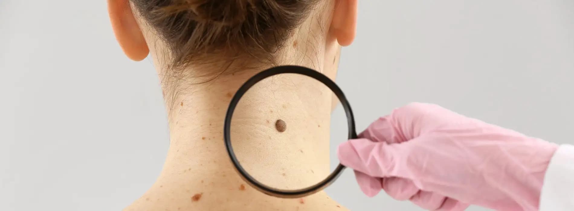 Czerniak - objawy, badania, leczenie i profilaktyka