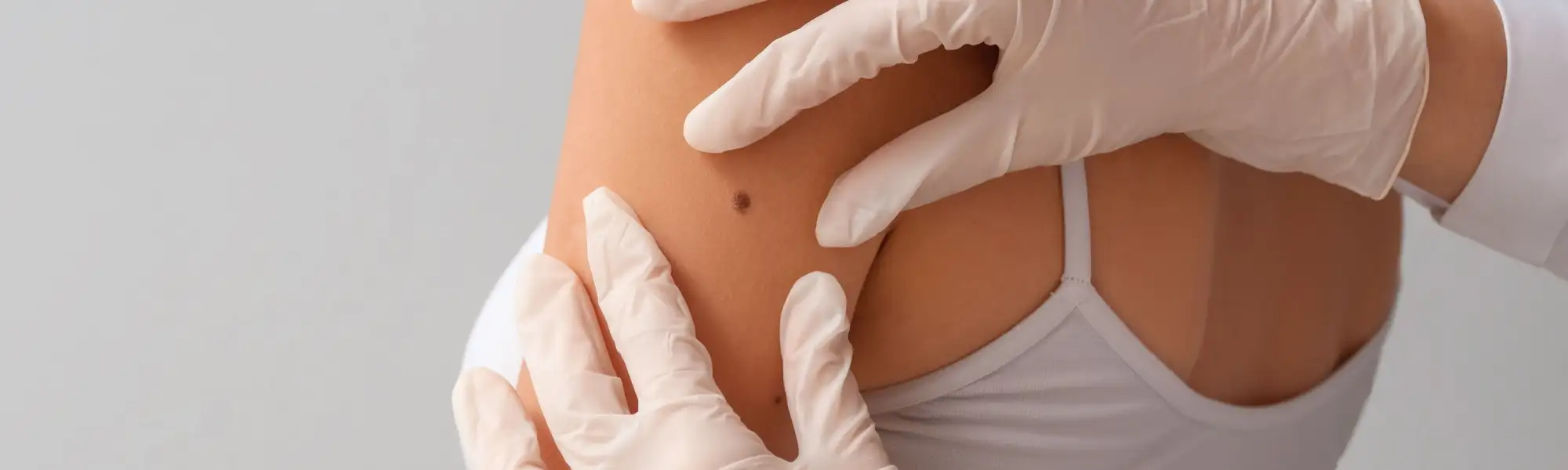 Czerniak skóry: jak zapobiegać i dbać o bezpieczeństwo skóry