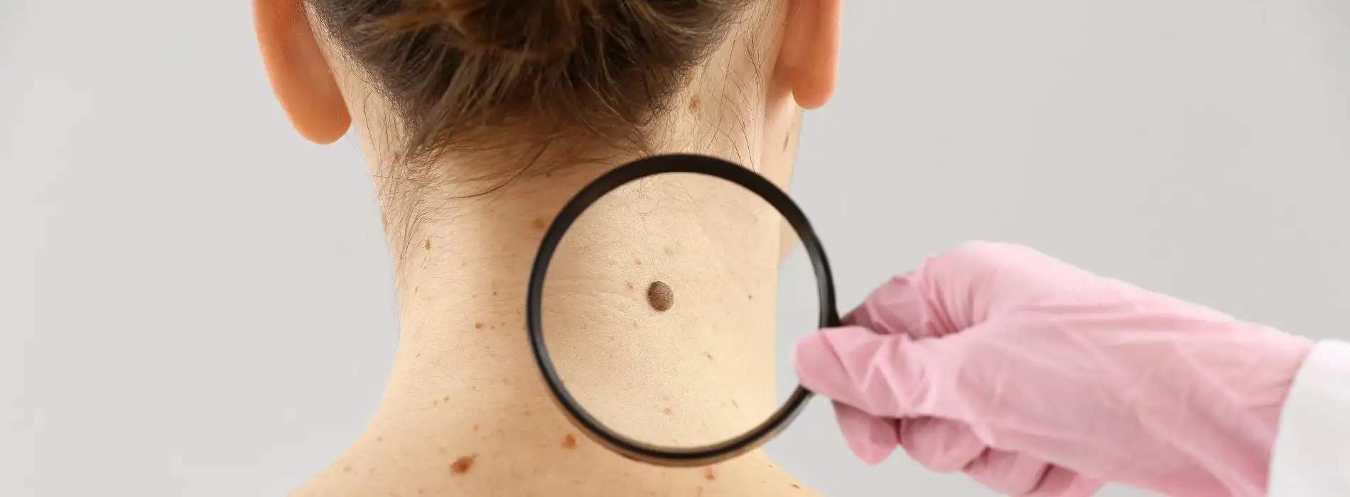 Czerniak - objawy, badania, leczenie i profilaktyka