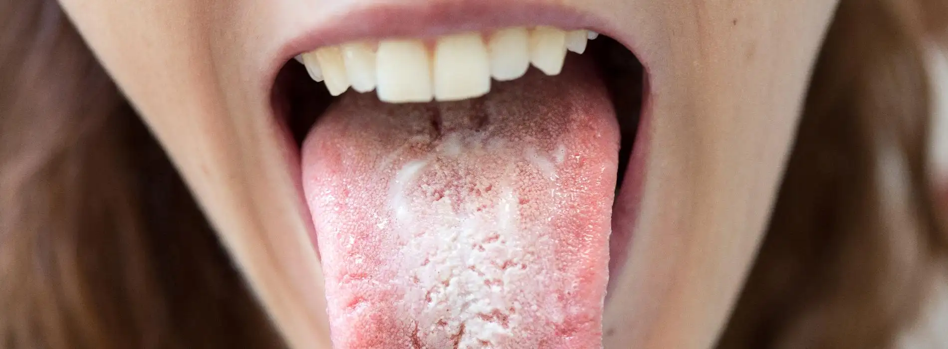 Kandydoza - przebieg, diagnostyka i dieta