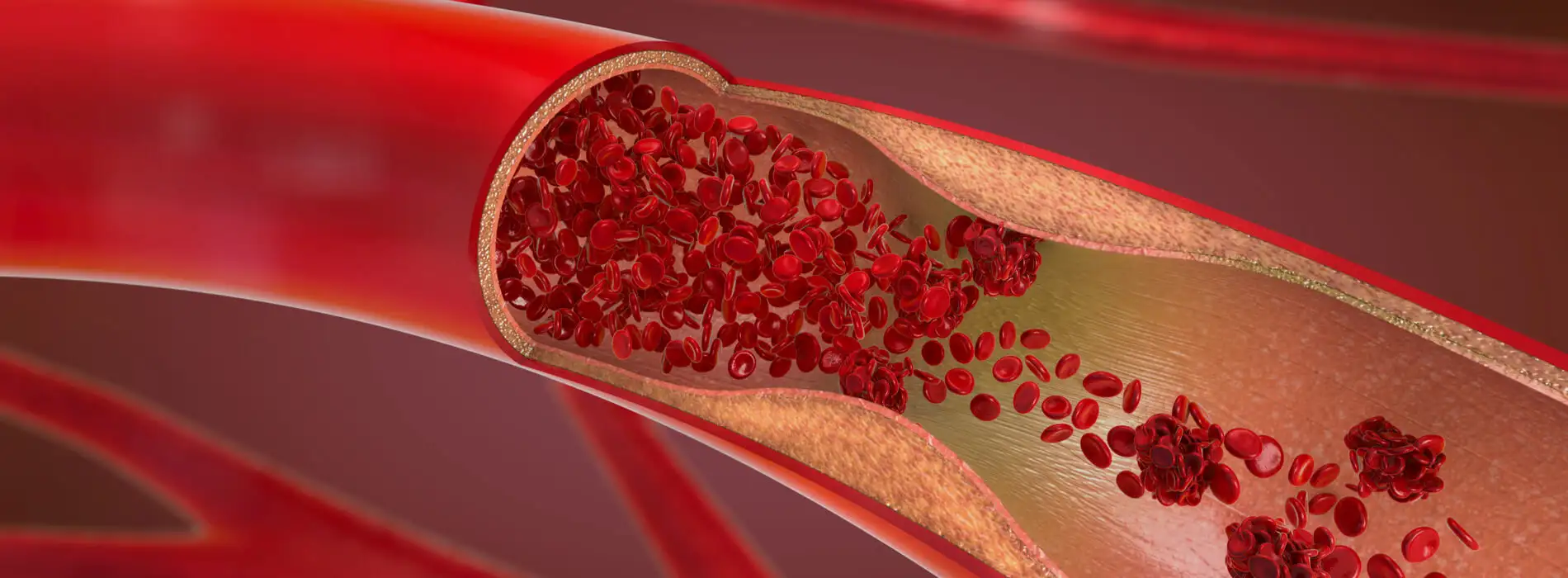 Powikłania zakrzepowo-zatorowe - kiedy występują i jak ograniczyć ich ryzyko?