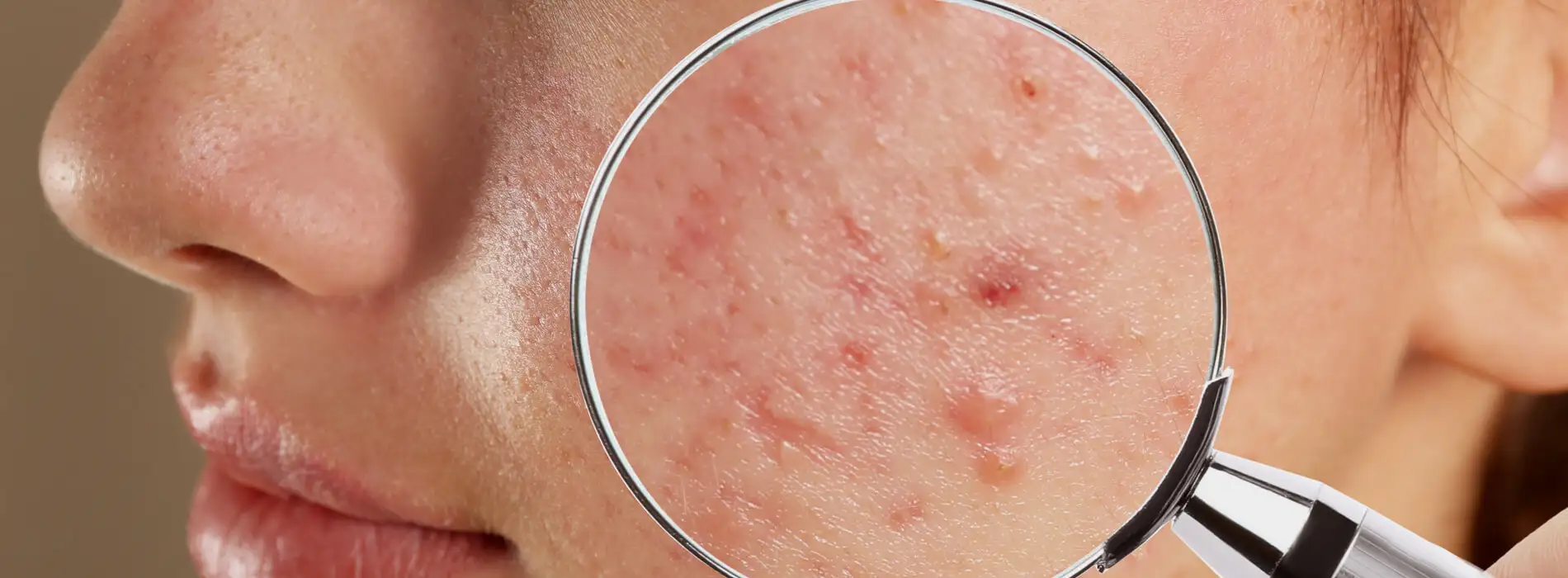 Trądzik - skąd się bierze i jak się go pozbyć?