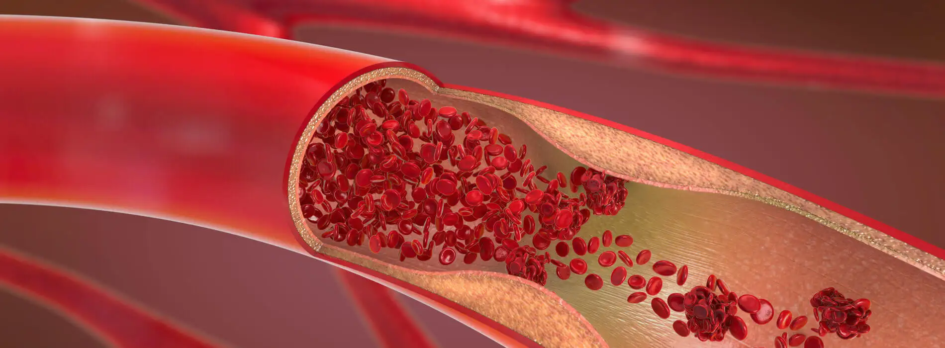 Zakrzepica u kobiet w ciąży groźna dla życia