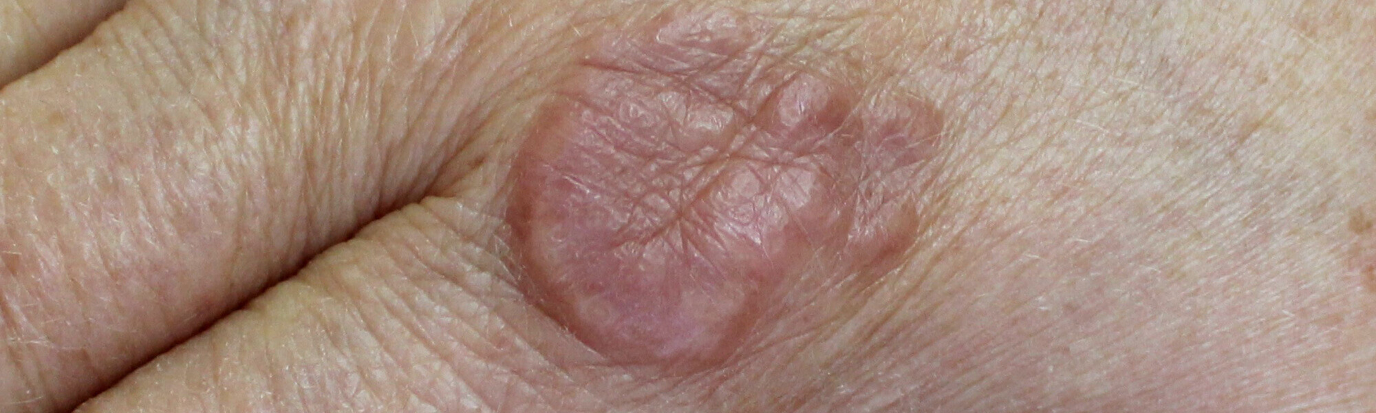 Objaw Raynauda — co to jest? Przyczny i leczenie zespołu Raynauda